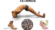 tetanus