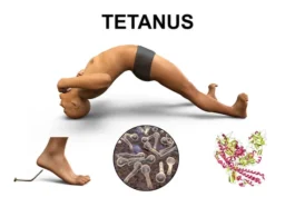 tetanus