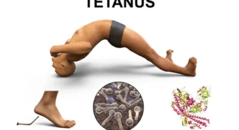 Tetanus: A Preventable Disease with Vaccination