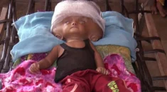 Hydrocephalus Diagnosis