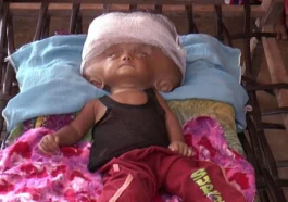 Hydrocephalus Diagnosis