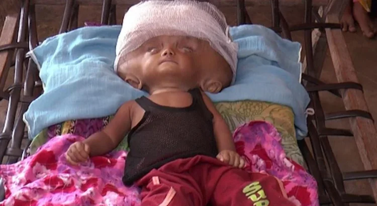 Hydrocephalus Diagnosis