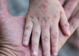 Singapore Flu in Kids