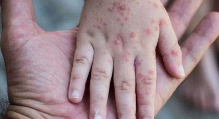 Singapore Flu in Kids