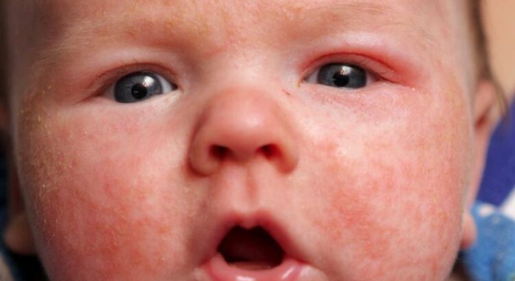 Childhood Skin Diseases