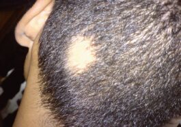 Hair Loss in Children