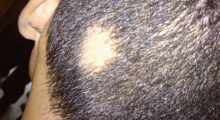 Hair Loss in Children