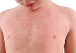 Heat Rash in Children