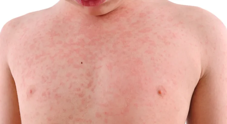 Heat Rash in Children