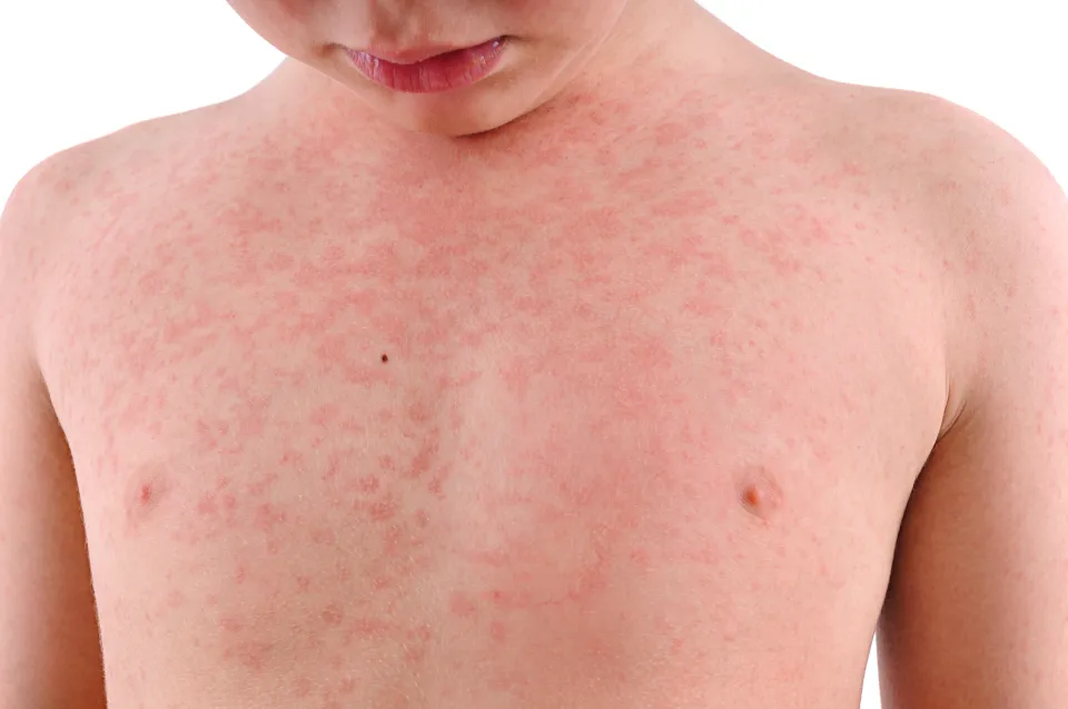 Heat Rash in Children