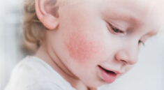 Identify Allergies in Children