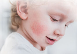 Identify Allergies in Children