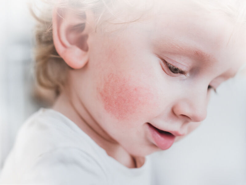 Identify Allergies in Children