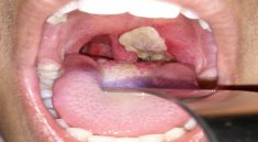 Impact of Diphtheria on Children