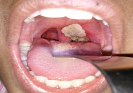 Impact of Diphtheria on Children