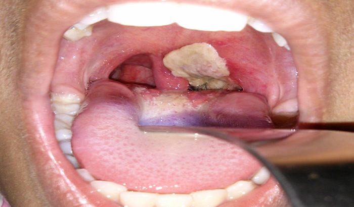 Impact of Diphtheria on Children