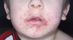 Impetigo in Children