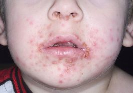 Impetigo in Children