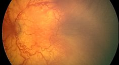 Retinopathy of Prematurity