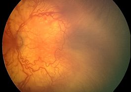 Retinopathy of Prematurity