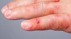 Scabies in Children