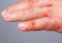 Scabies in Children