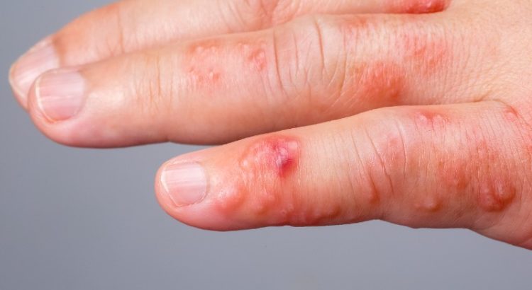 Scabies in Children