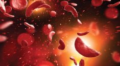 Sickle Cell Disease