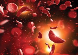 Sickle Cell Disease