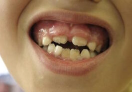 Swollen Gums in Kids