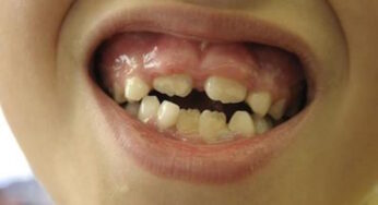 Natural Remedies for Swollen Gums in Kids: What You Can Do