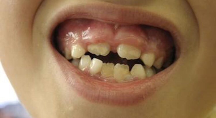 Swollen Gums in Kids