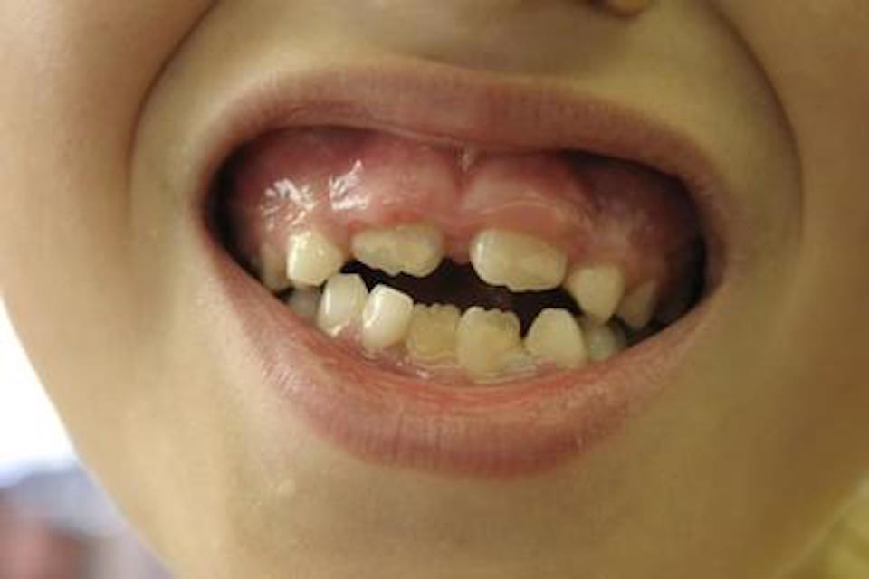 Swollen Gums in Kids