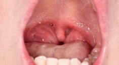 Tonsillitis in Children
