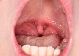 Tonsillitis in Children