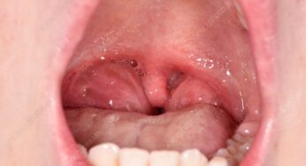 Tonsillitis in Children: When to Worry and Seek Medical Attention