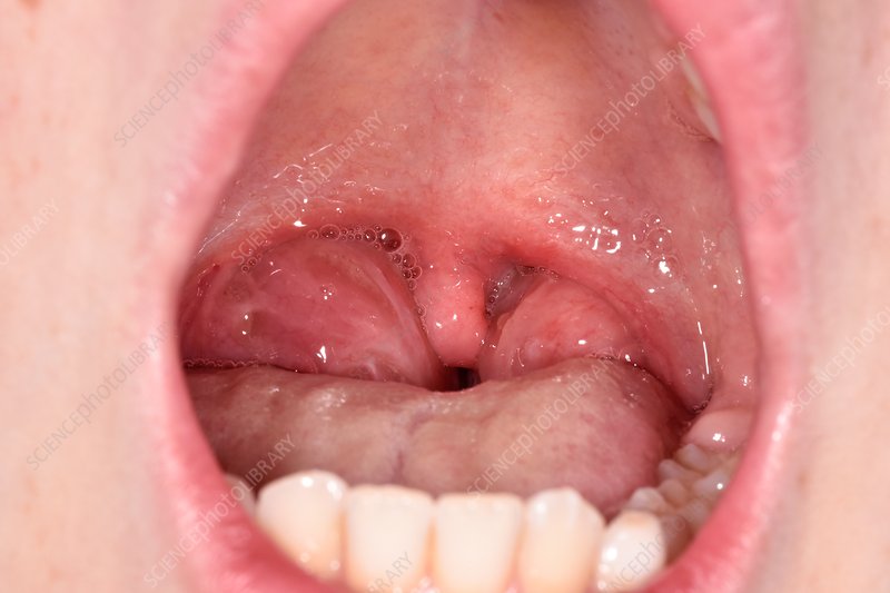 Tonsillitis in Children