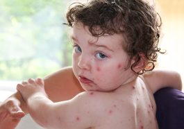 Chickenpox in Children