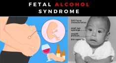Child with Fetal Alcohol Syndrome