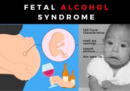 Child with Fetal Alcohol Syndrome