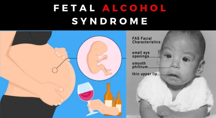 Child with Fetal Alcohol Syndrome