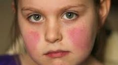 Childhood Lupus
