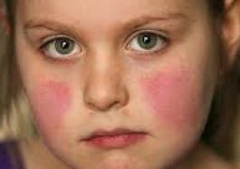 Childhood Lupus