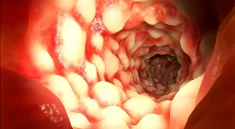 Crohn’s Disease