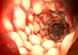 Crohn’s Disease