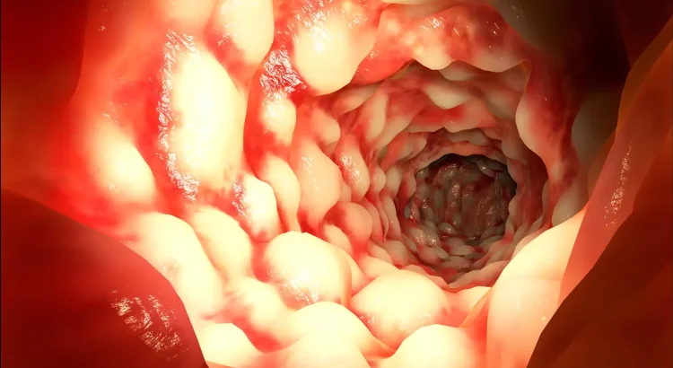 Crohn’s Disease