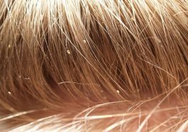 Head Lice in Schools