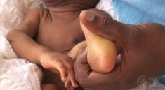 Jaundice in Children