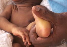 Jaundice in Children