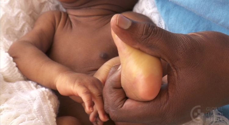 Jaundice in Children